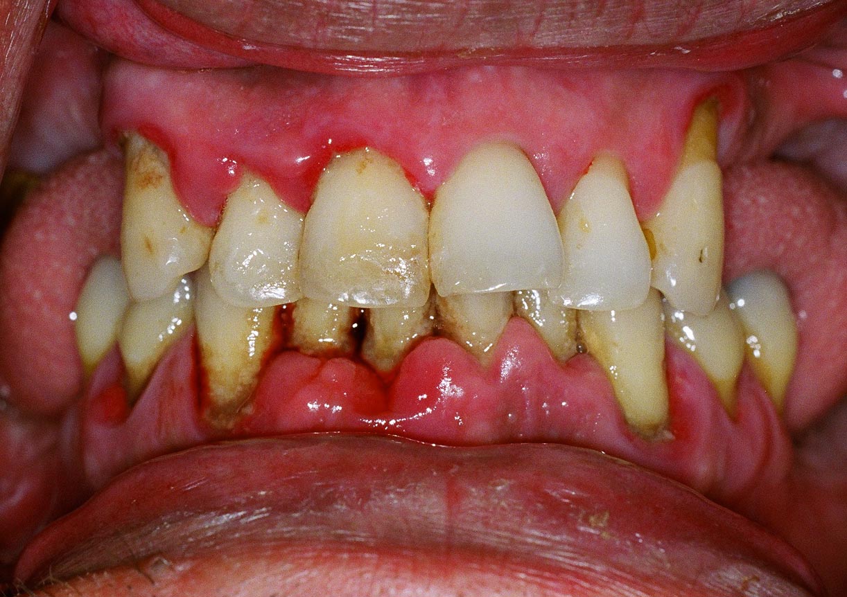 What are the symptoms of periodontal gum disease?